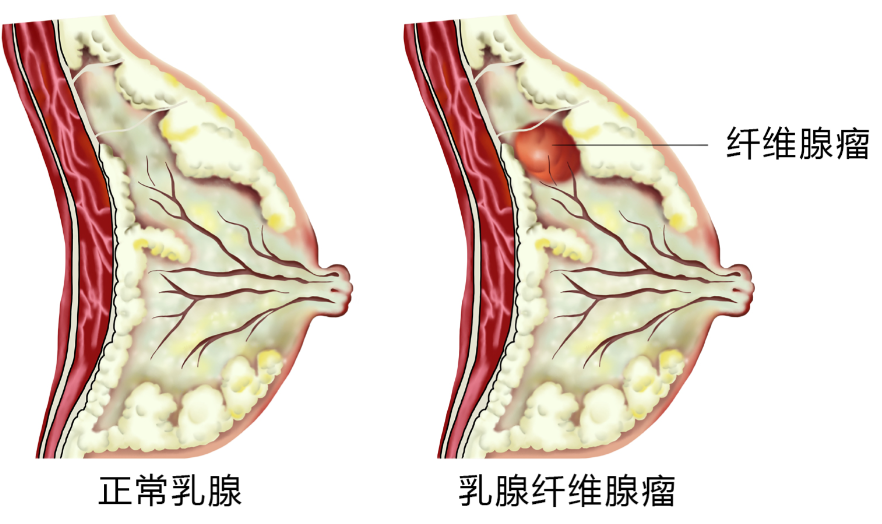 乳核是中医学里的一个名词,指乳房常见的良性肿瘤