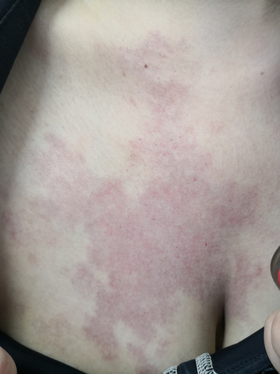 前胸鲜红斑痣症状#解决皮肤问题专注皮肤美容##血管瘤# 可以使用激光