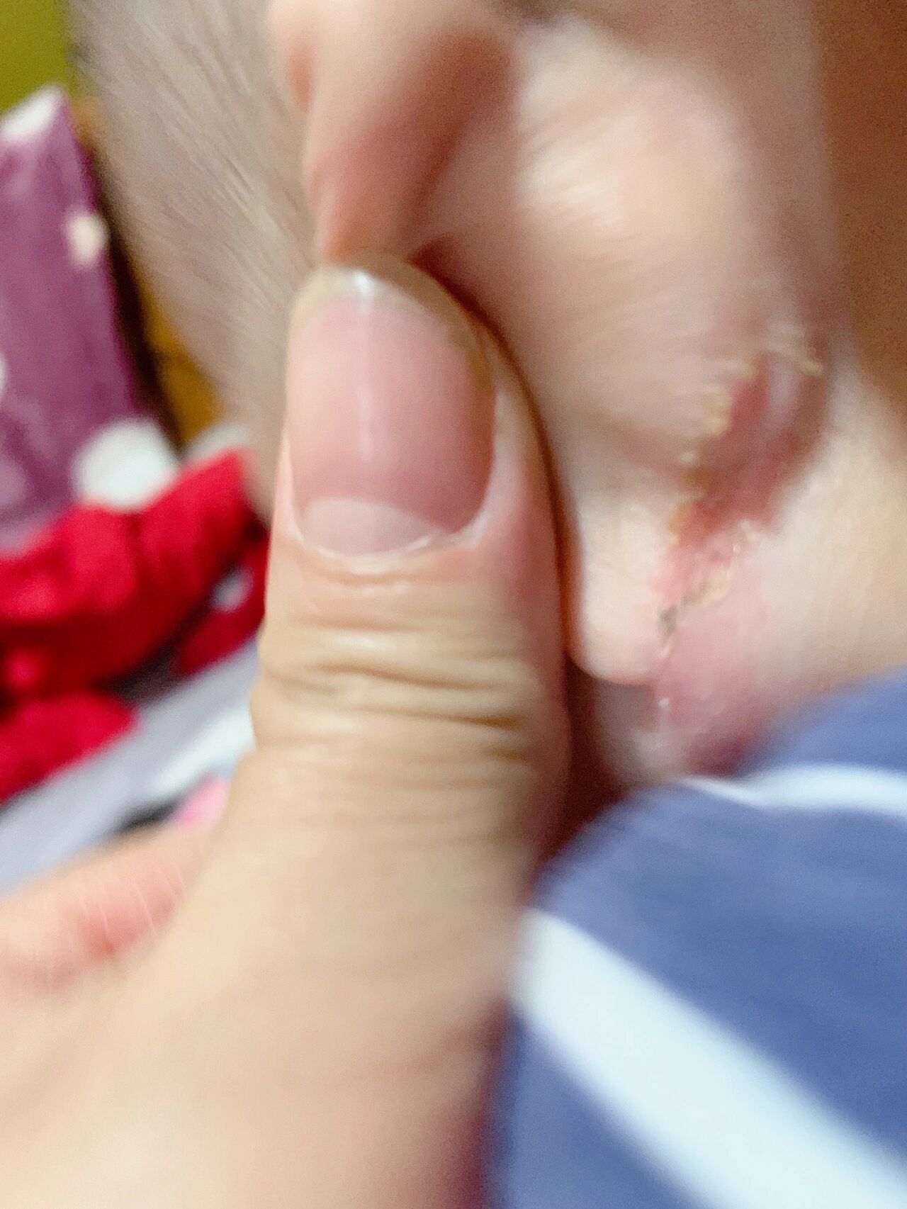 旋耳疮,耳后根淹了 耳后根淹了,反反复复,现在终于见好了.