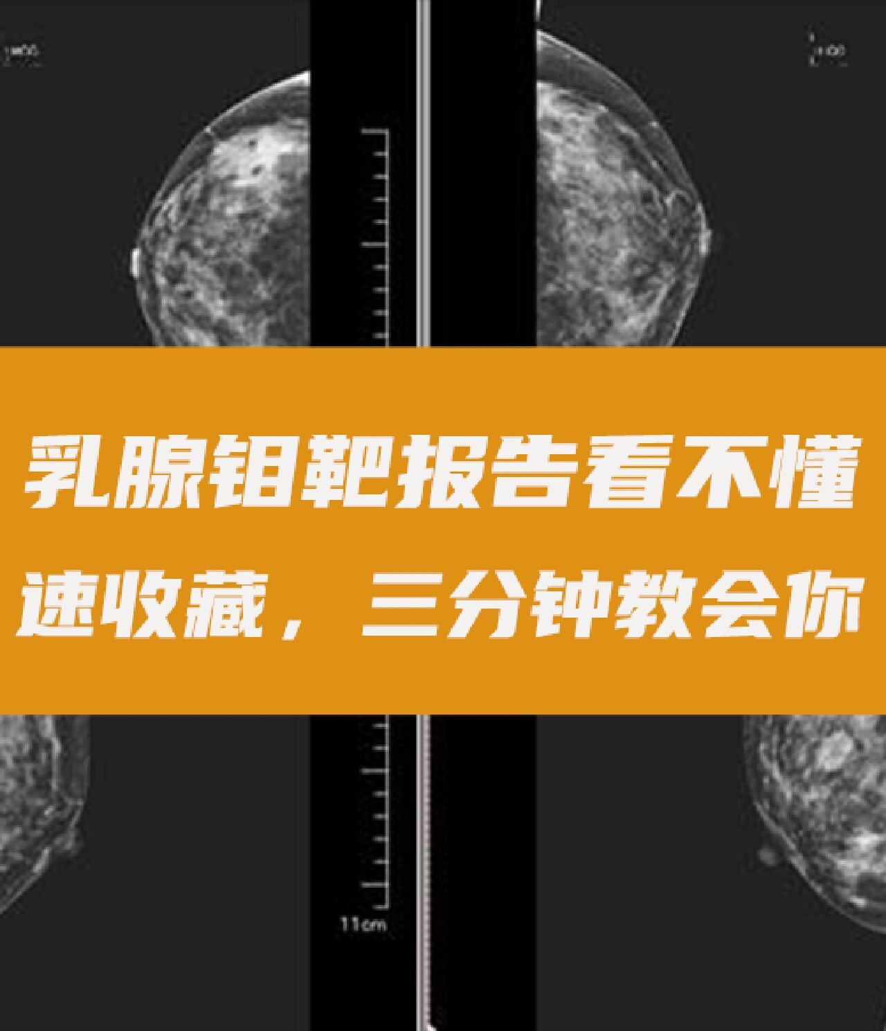 速收藏,三分钟教会你 乳腺钼靶报告📝可以说是乳腺癌的"判决书"