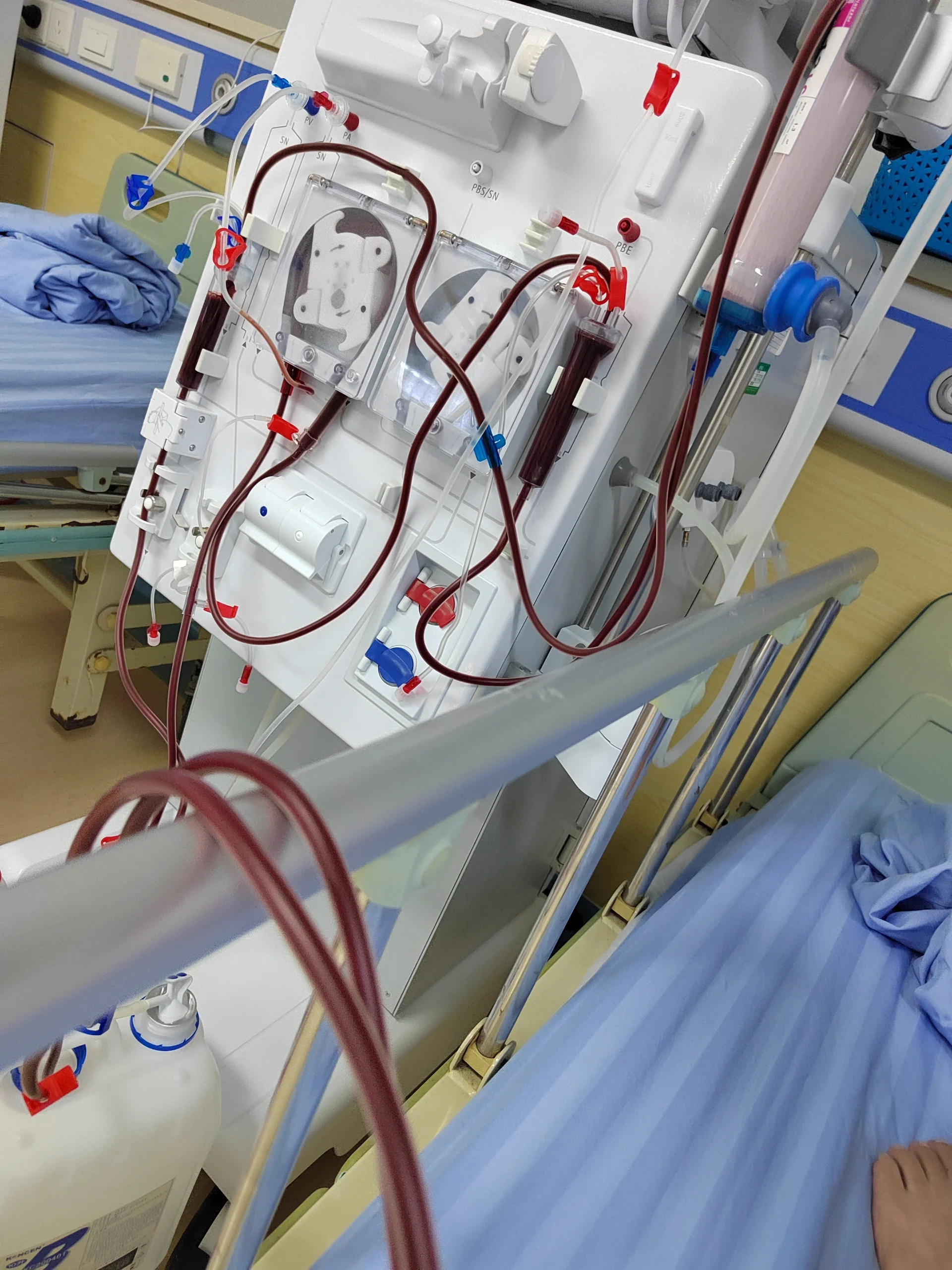 尿毒症 记录血透的第一天,插了临时管,真的很难受