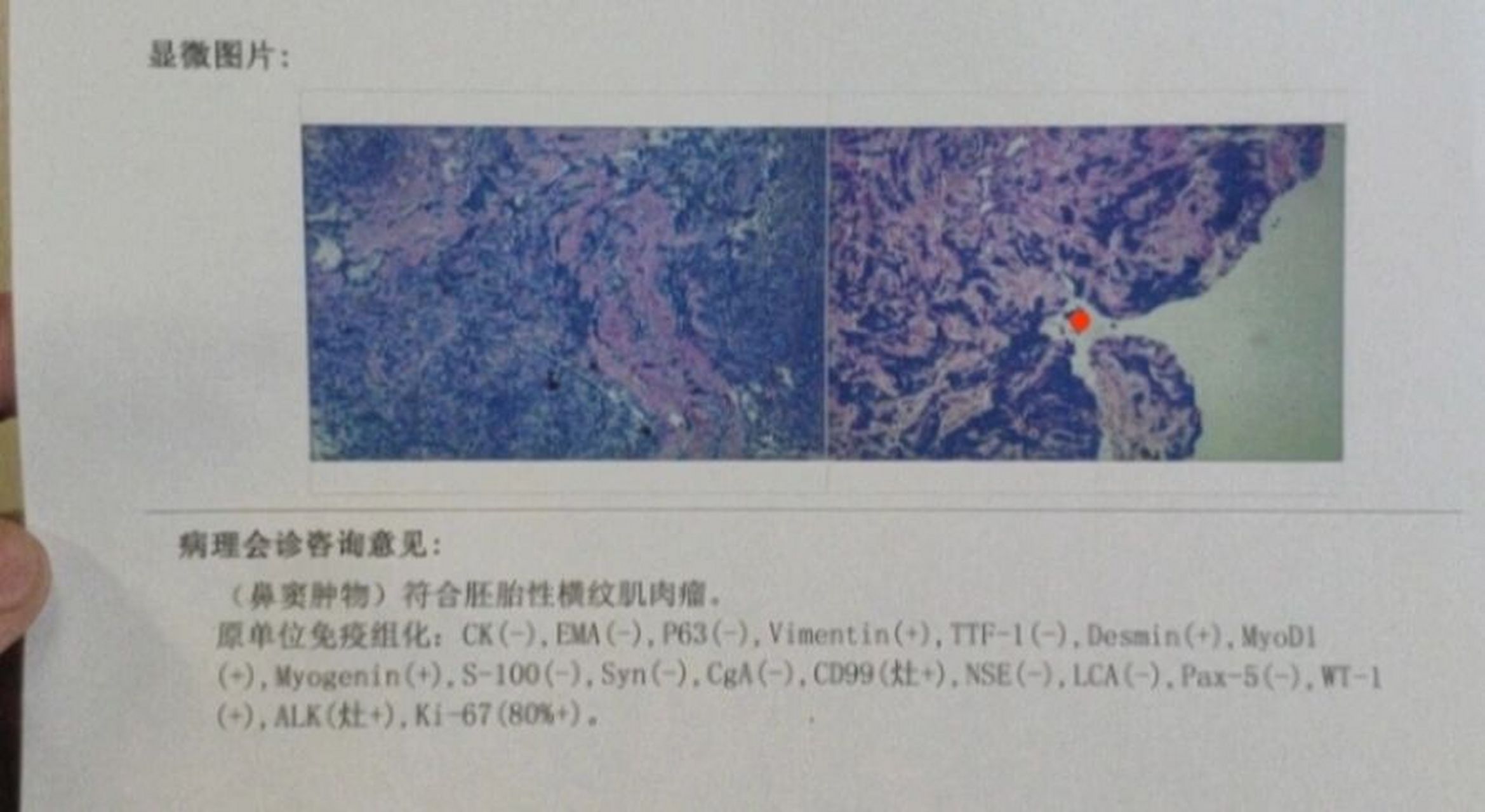 关于横纹肌肉瘤,或许医生会无意中把你坑了 我是医生,也是病人,由于