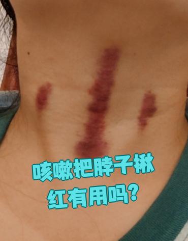 咳嗽时把脖子揪红其实没啥用,这种方法没有科学依据能证明它能治病