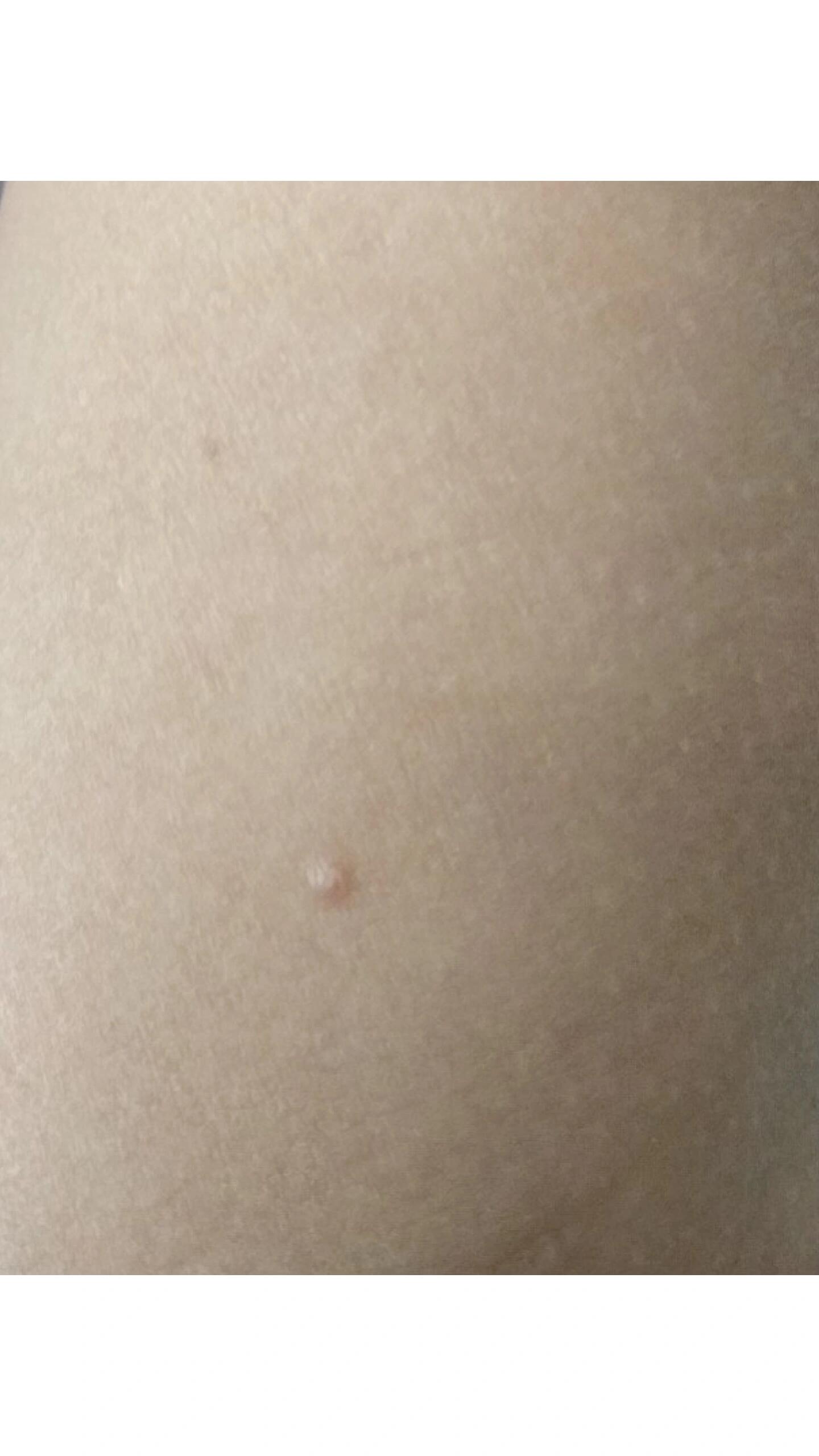 软疣俗称水猴子 全程无痛不腐蚀不留印痕