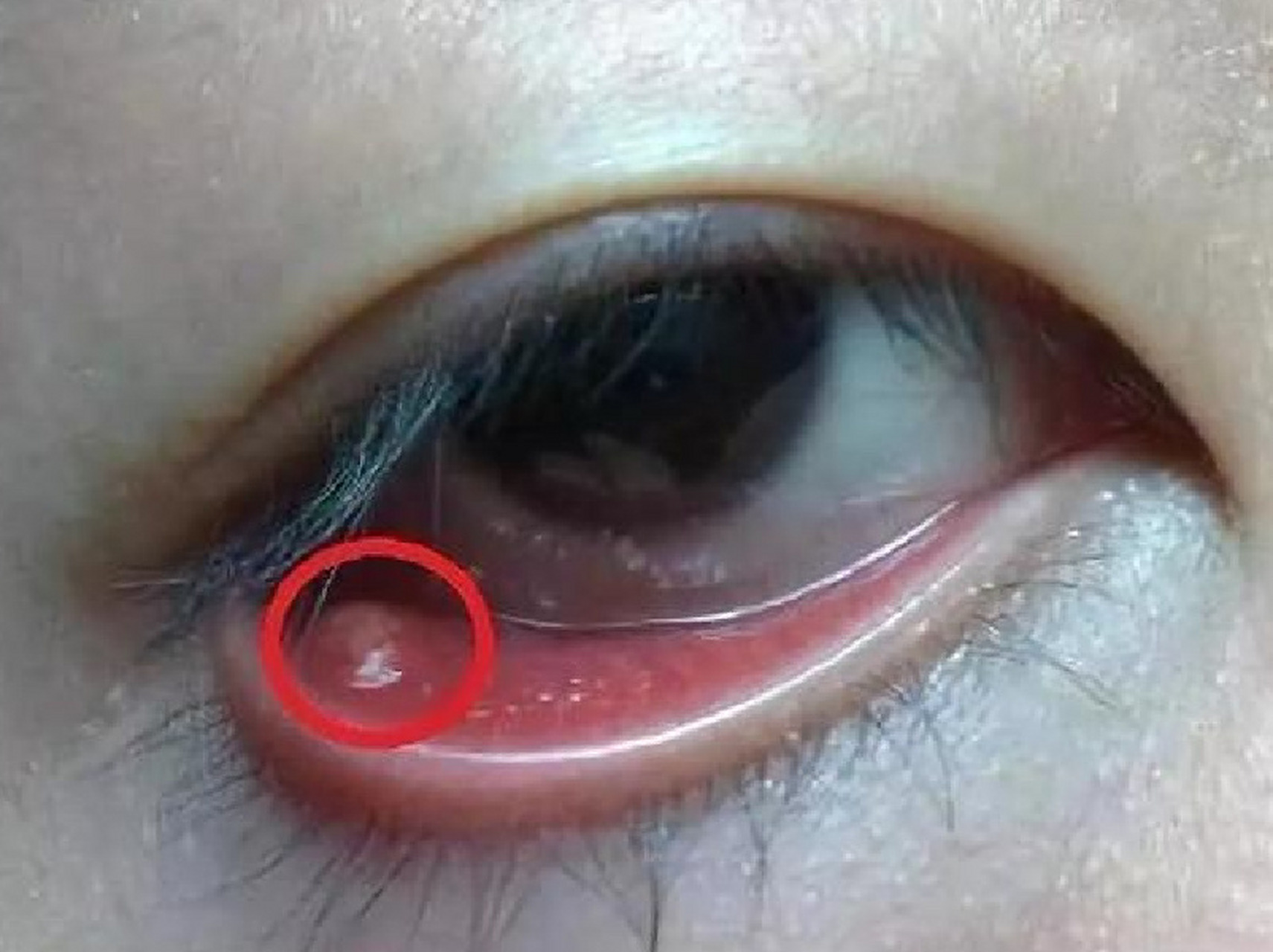 睑腺炎又叫"麦粒肿"或"针眼".多为葡萄球菌感染. 	 1