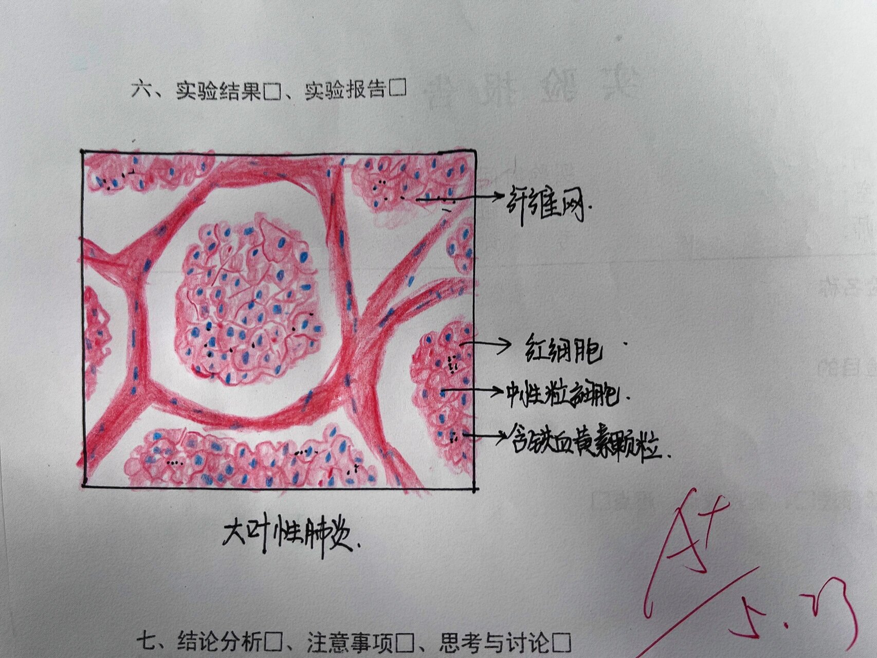 动脉粥样硬化红蓝铅笔图片