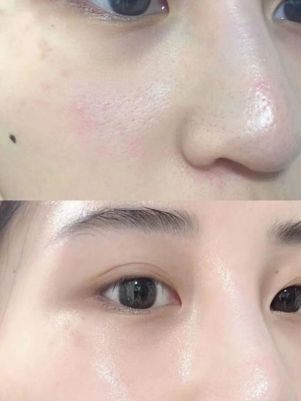 因为水光针是需要针剂直接导入到自己的皮肤内部的,这个时候脸部就