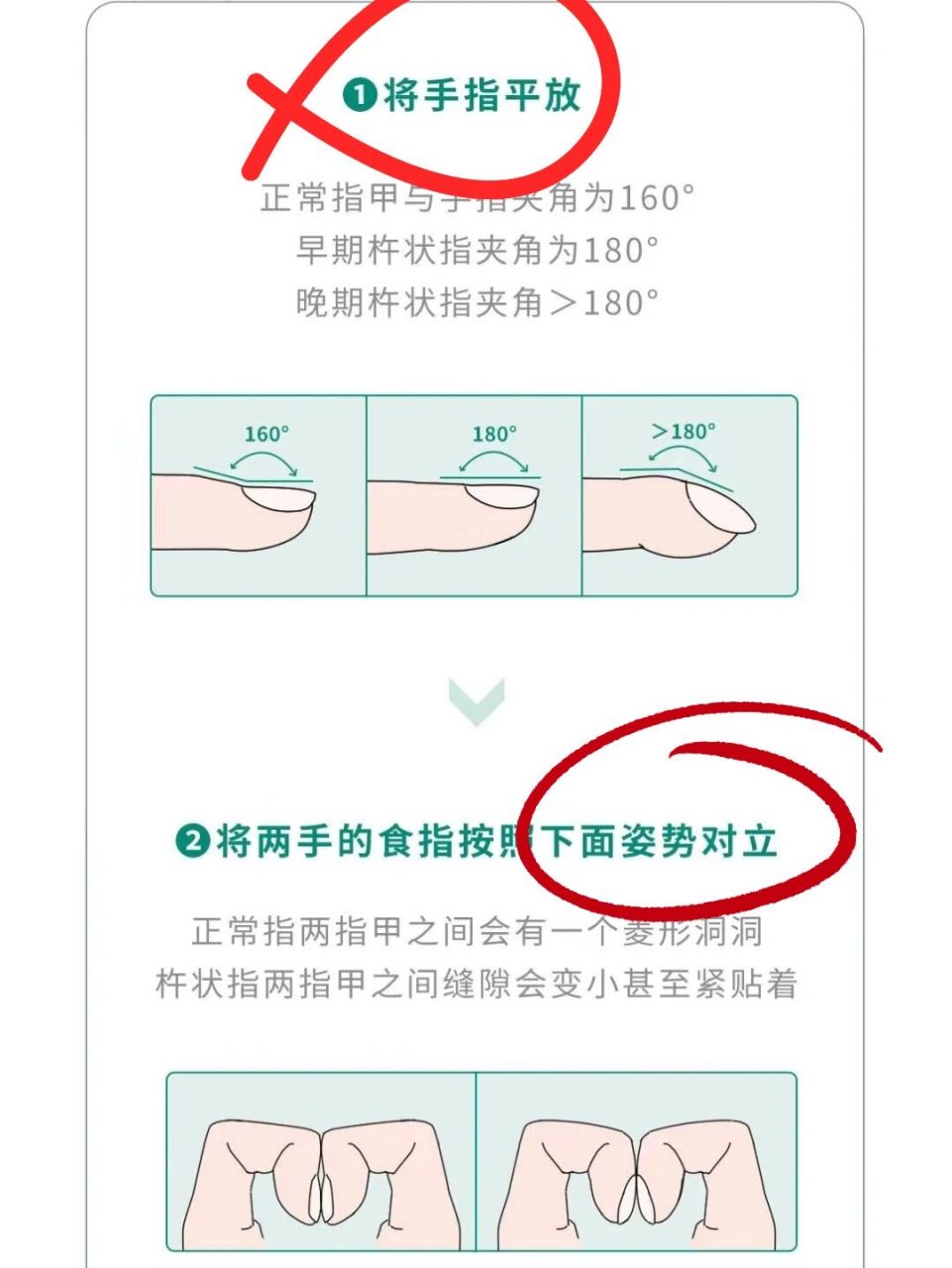刷到有些姐妹担心自己是不是杵状指,今天在公众号正好看到自查的方法