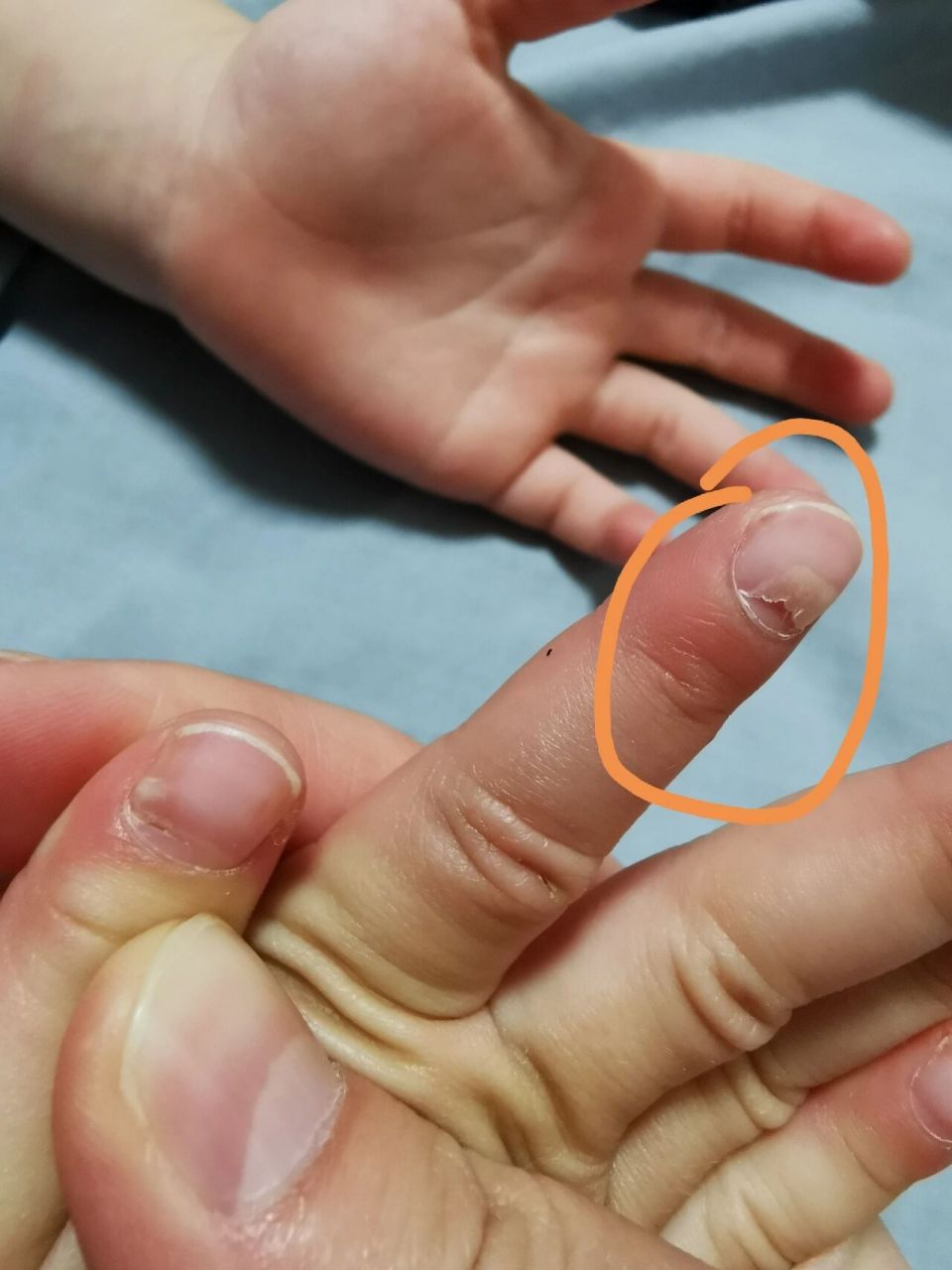 最近发现小朋友指甲食指和中指要断开.这是为什么呢?求解