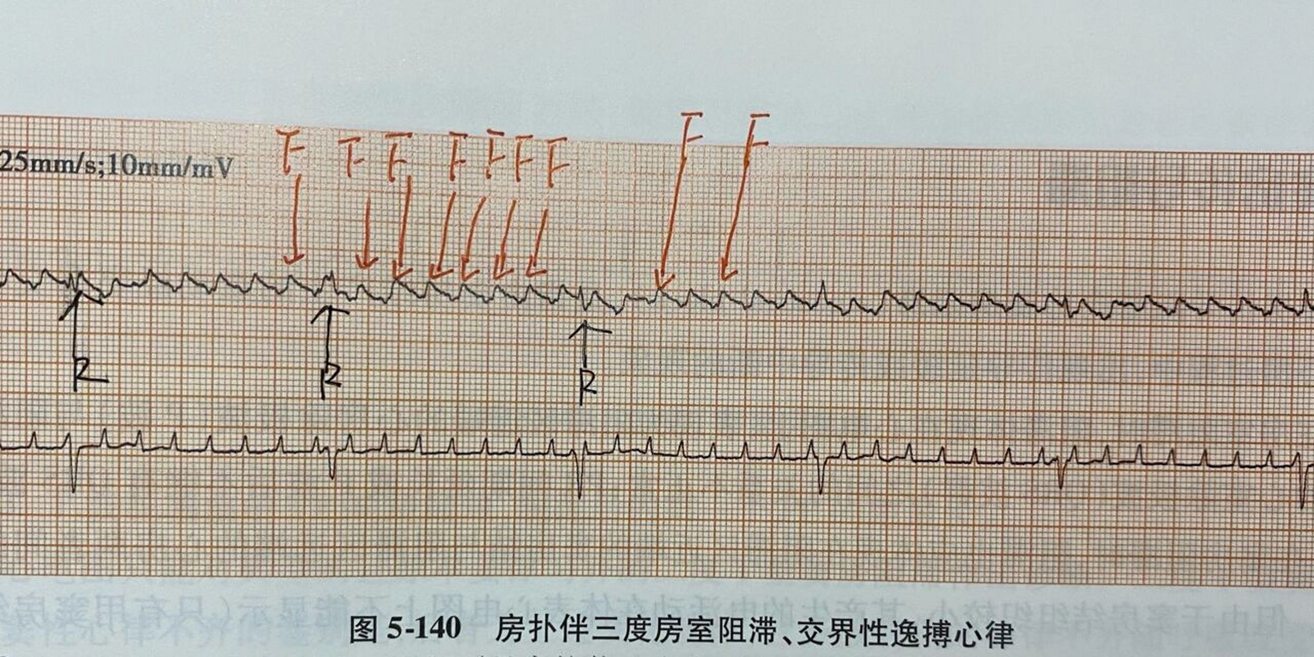 简易心电图(房颤,房扑伴三度房室传导阻滞) 7815房颤伴三度:166