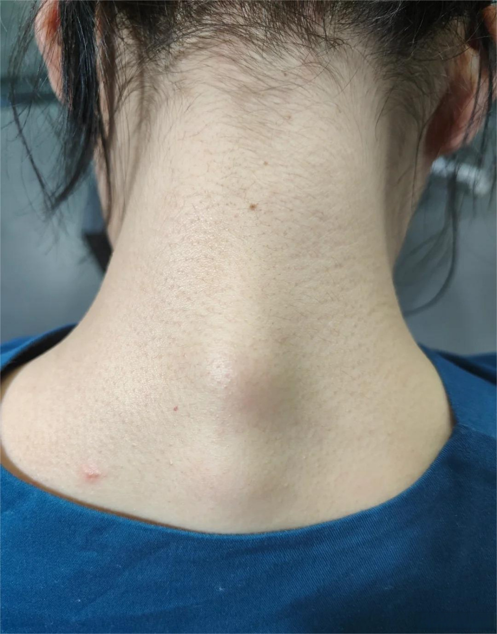 一般大家发现自己脖子后面也是这种情况 会不会觉得自己有富贵包呢