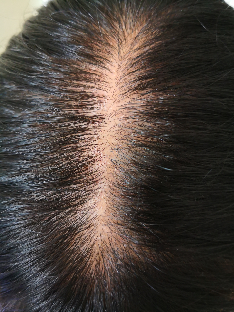 哺乳期妇女头皮干燥脱屑瘙痒症状明显.脱发较多.