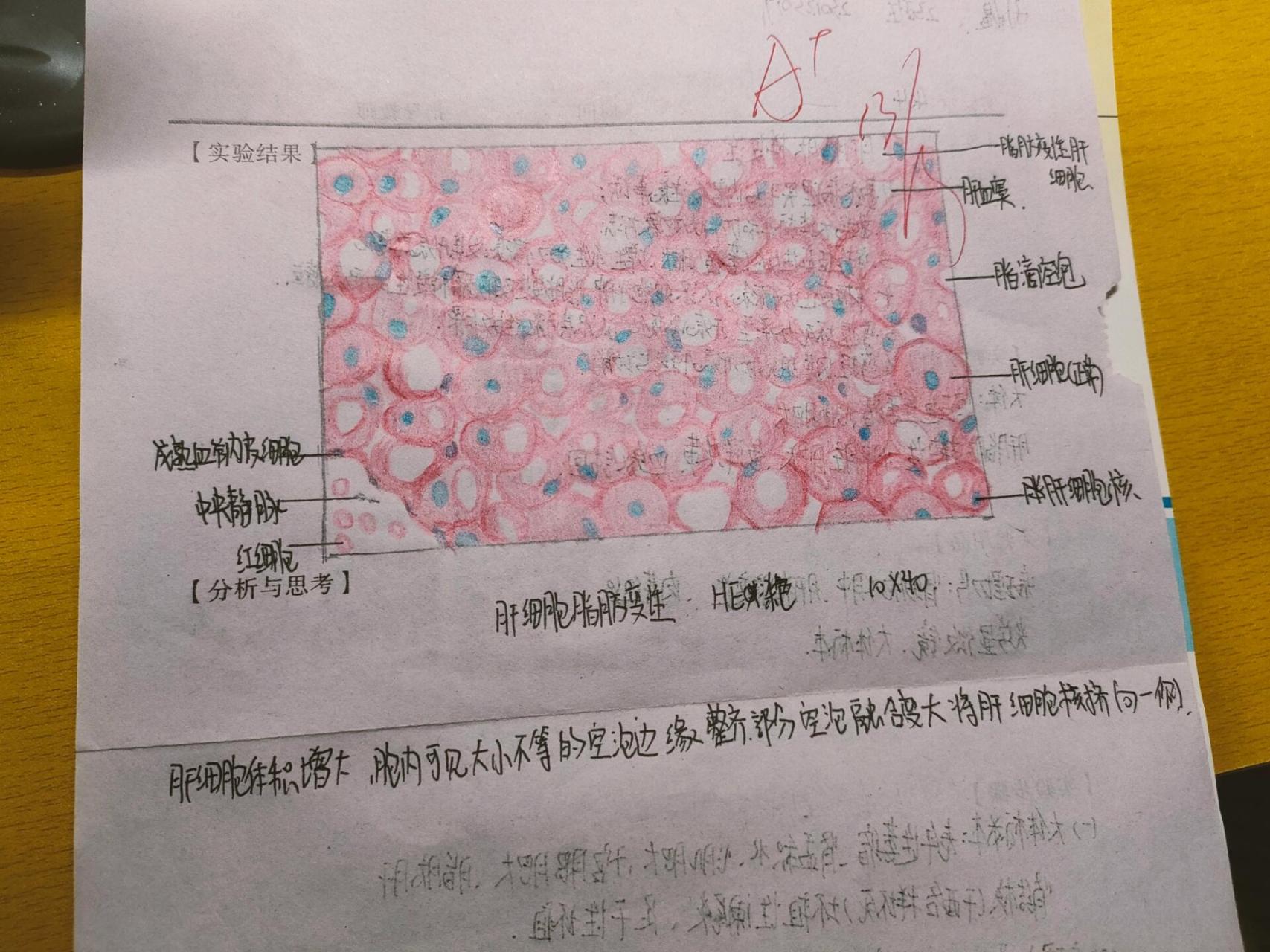 肝细胞脂肪变性 红蓝铅笔