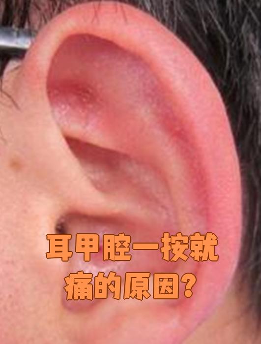 耳甲腔一按就疼,最常见的原因是外耳道炎或外耳道疖肿