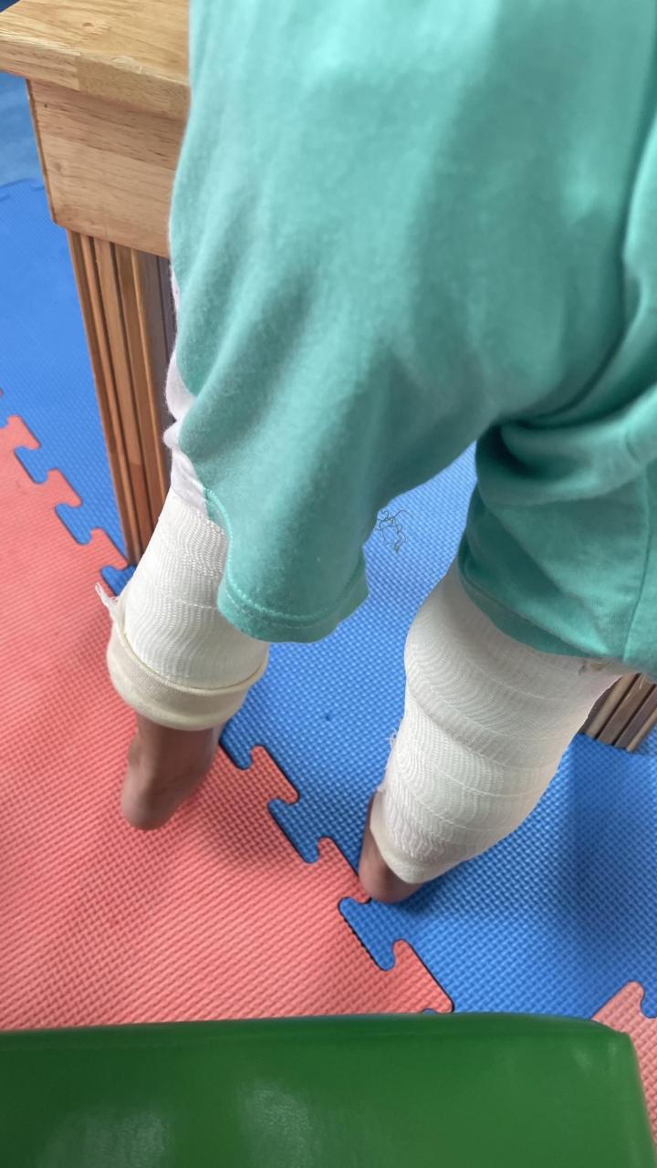 对于膝关节受限的,脑瘫患儿,打石膏是个不错的法子