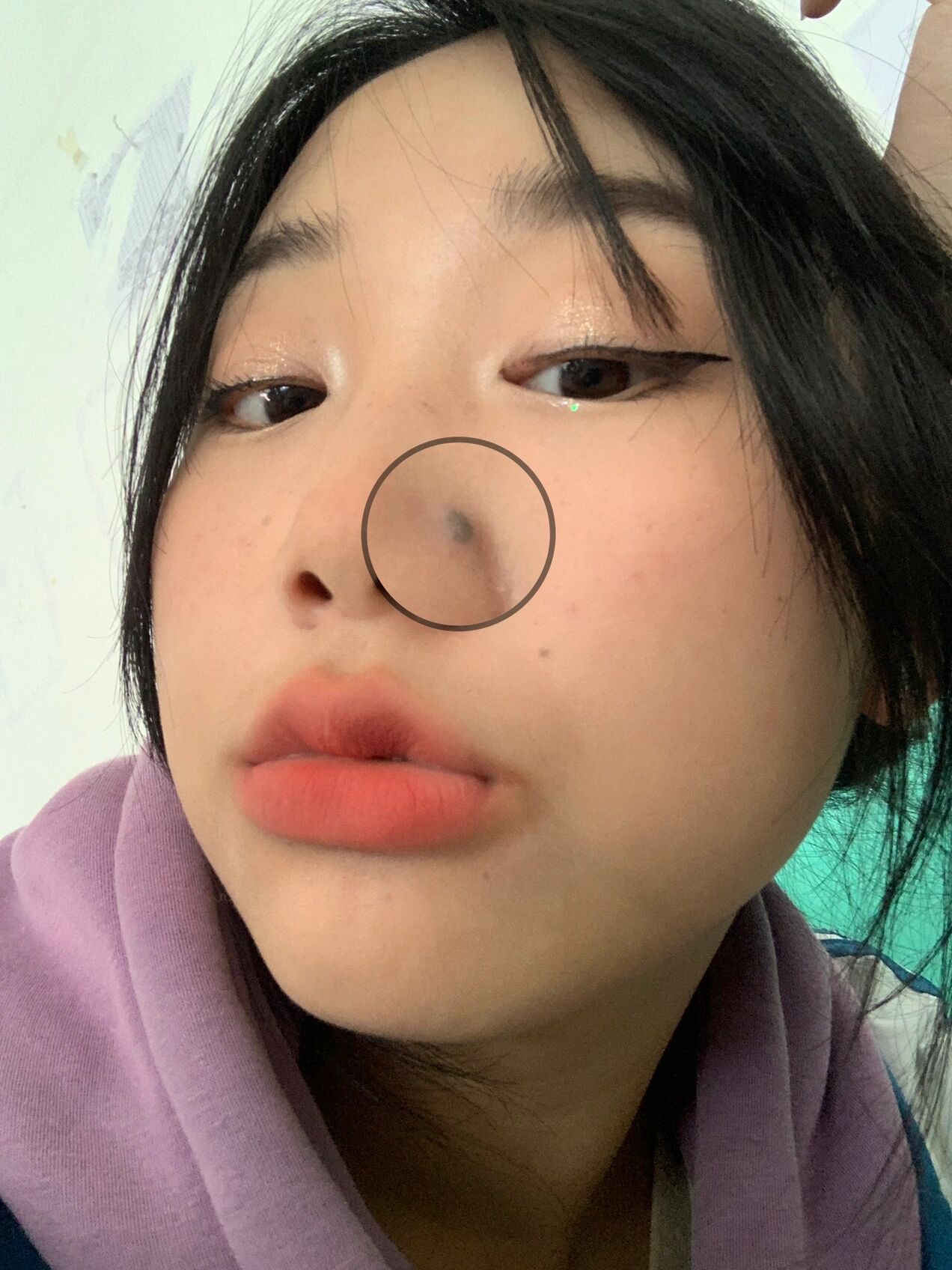 鼻子上的痣|到底祛不祛得啊🤔 这个痣我从小就有 张了好久好久 有人