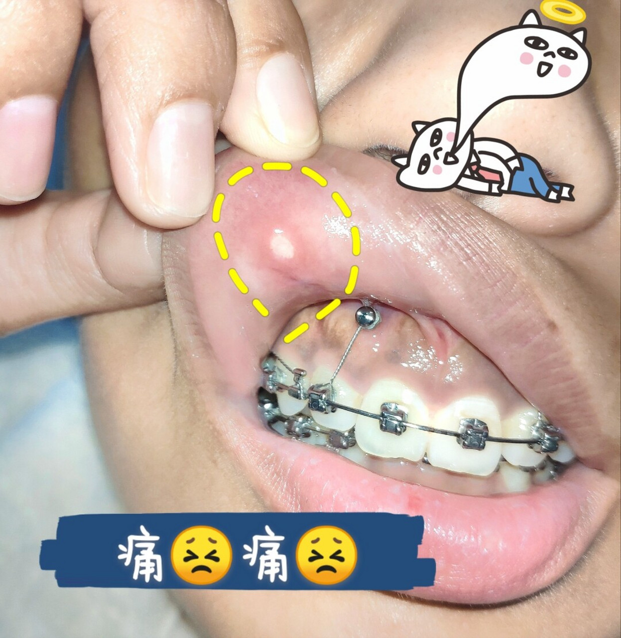 支抗钉托槽各种刮嘴磨嘴,溃疡一大片!