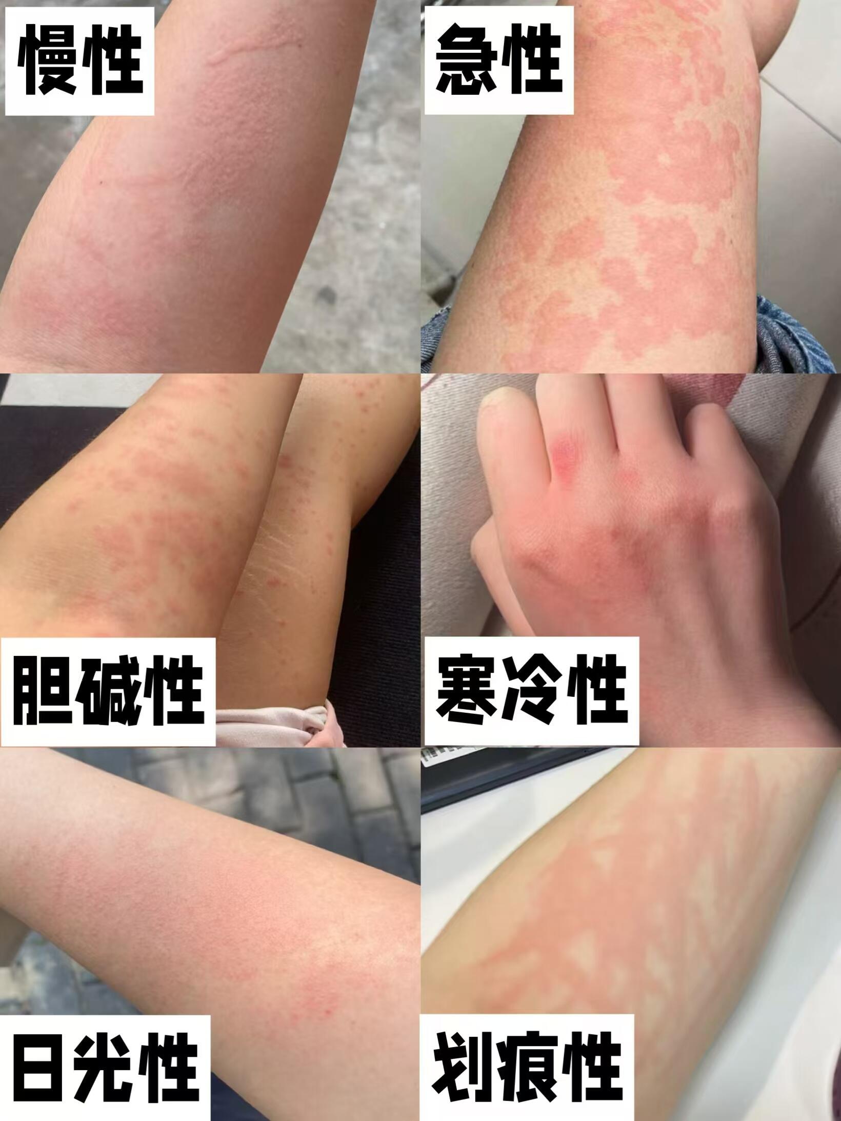 荨麻疹6大类型,分清类型轻松应对✅