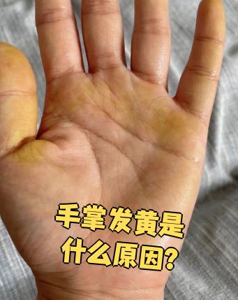 手掌发黄可能和饮食,药物,肝脏问题或者溶血性贫血有关