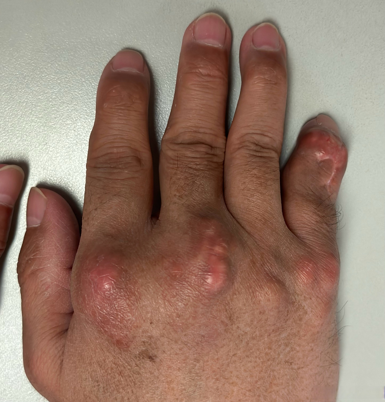 微博健康公开课##医生日记# 【痛风石手变形,类似的错误还在犯】这是