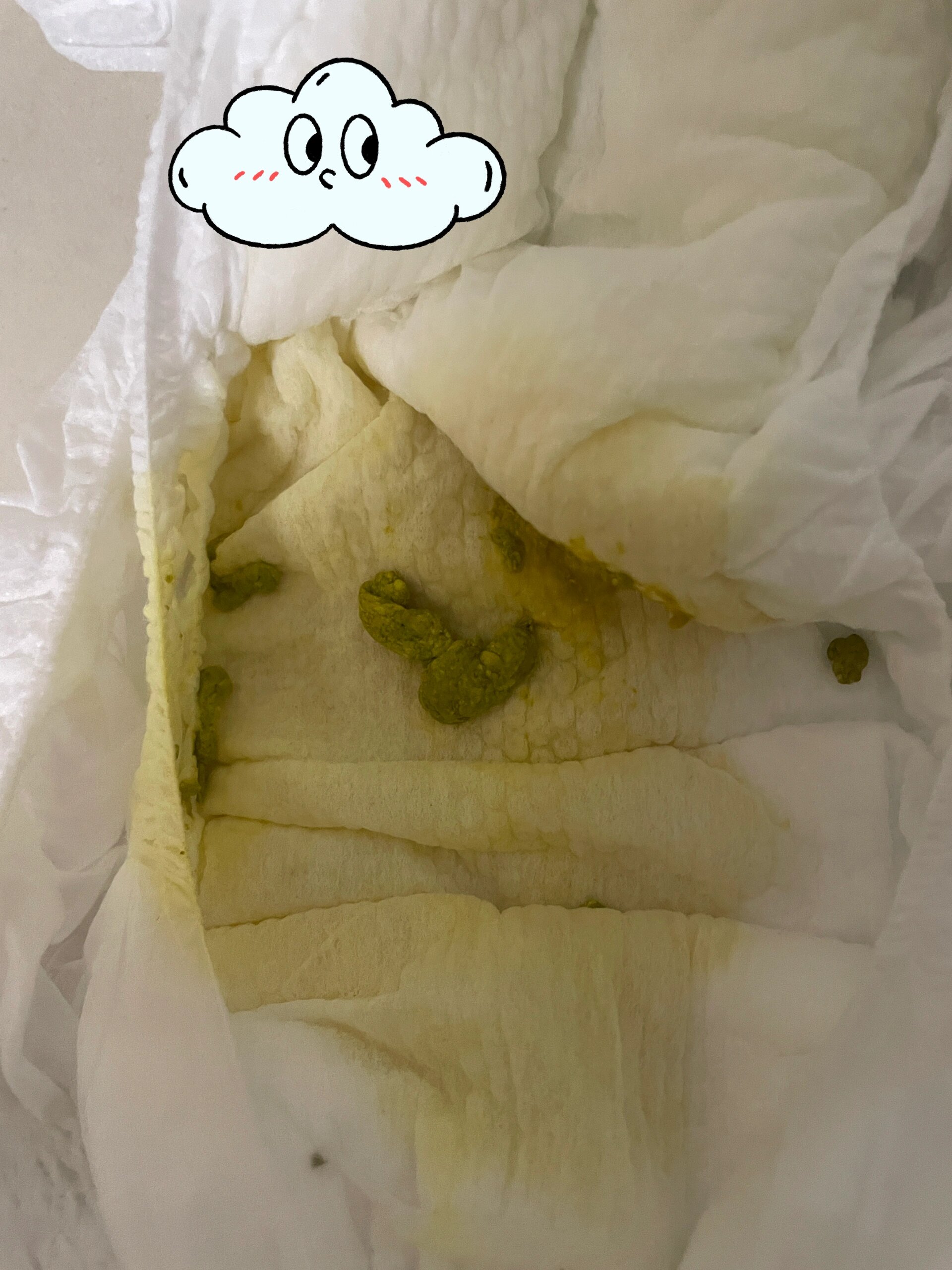 去了医院检查说是病毒感染,吃完药便便是这样 最近拉出来的大便就是图