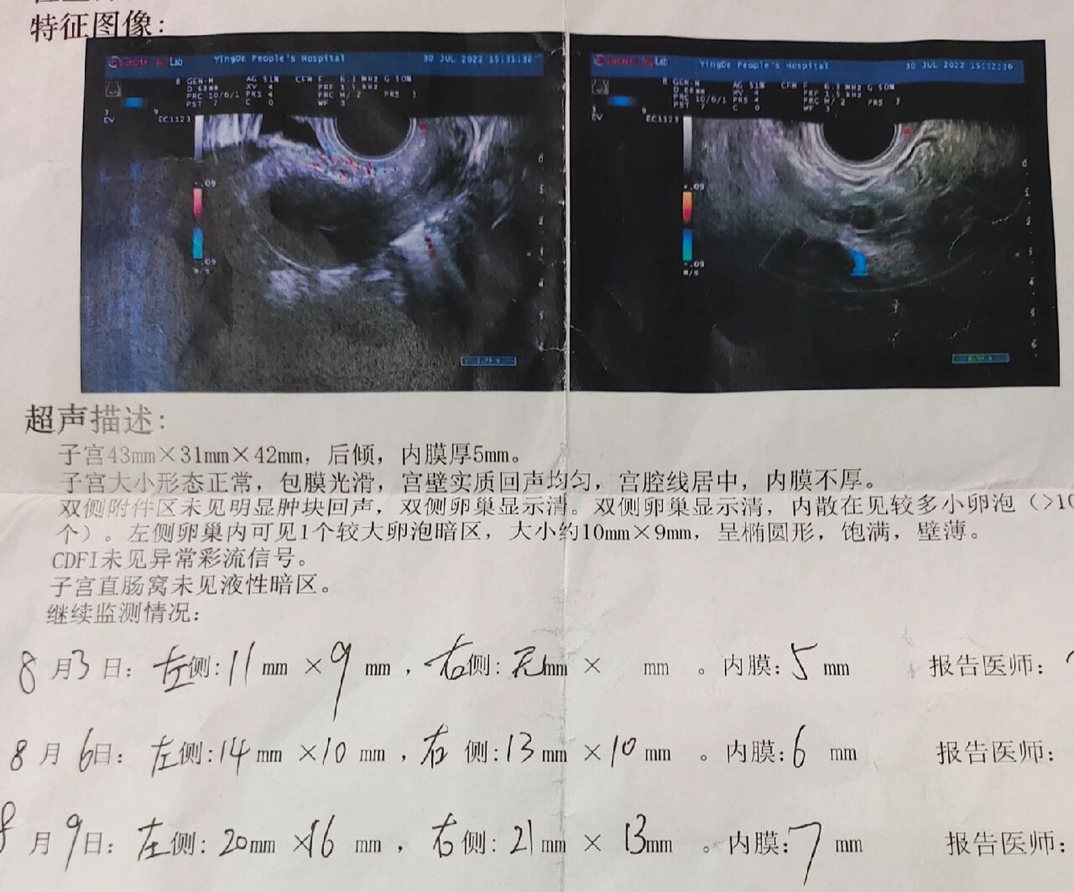 三级卵泡图片