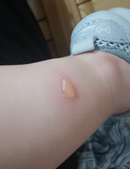 为什么蚊子咬了会起水泡怎么办为什么在线