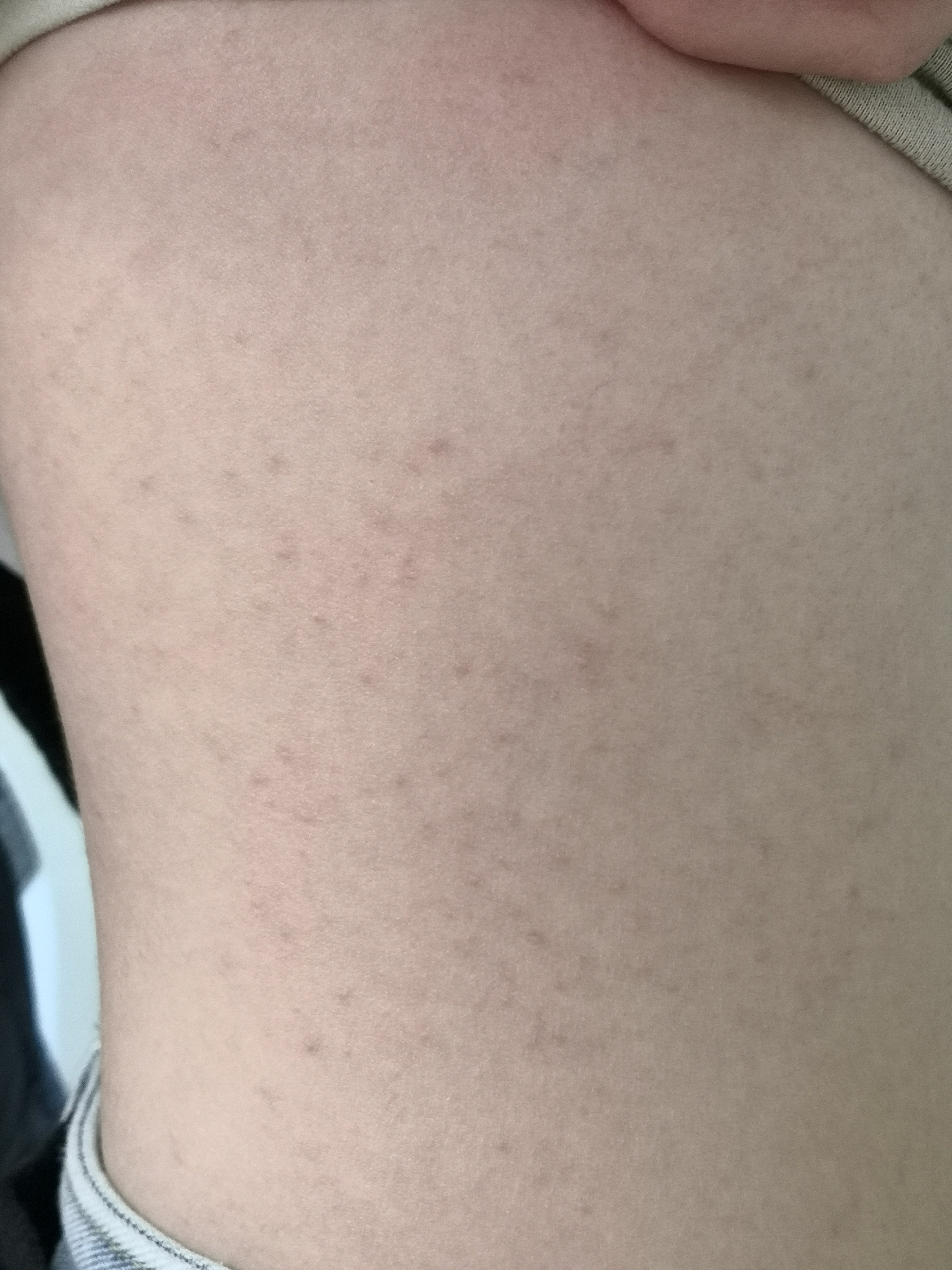 躯干部位出现的丘疹红斑症状.皮疹长轴与皮纹走形一致 #玫瑰糠疹