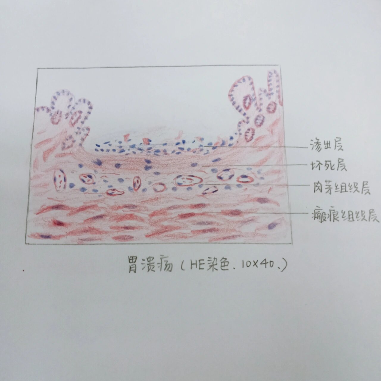 胃溃疡镜下手绘图图片