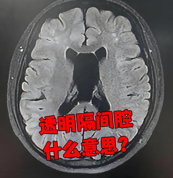 透明隔间腔是两侧侧脑室之间的间隔结构