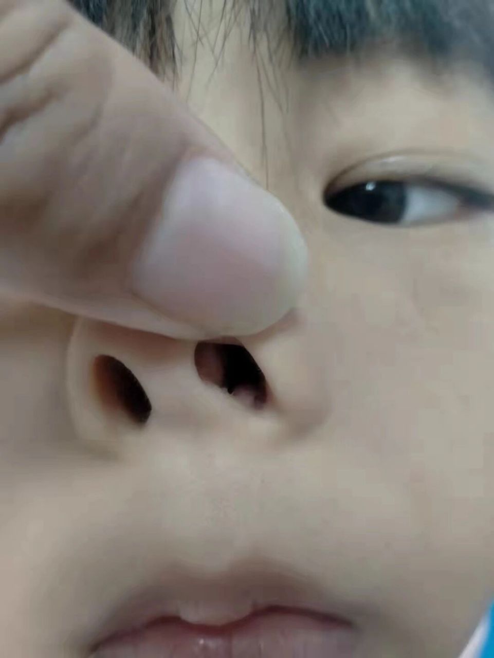 鼻孔疣图片图片