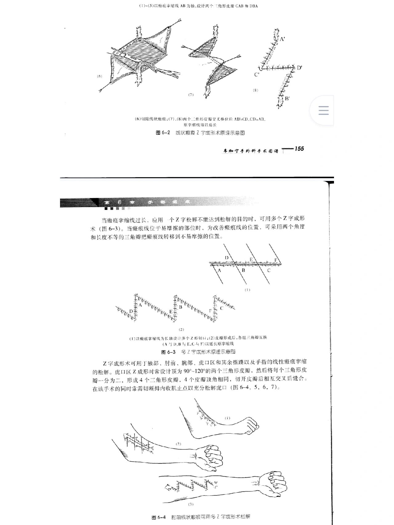 z字缝合方法图解图片