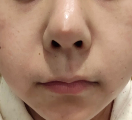 隆鼻手术是可以取出的