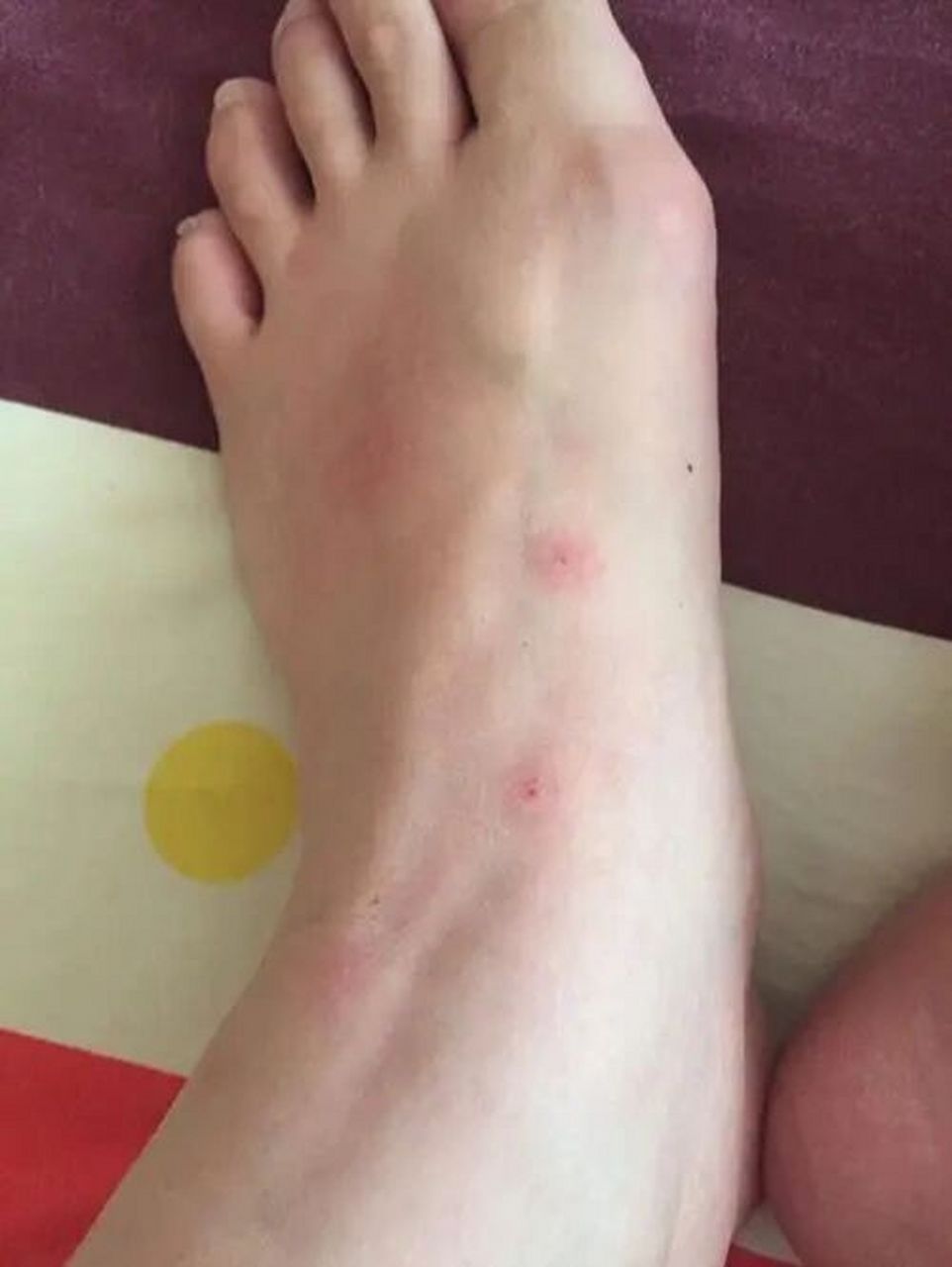脚上越抓越痒有小疙瘩肿了 脚上越抓越痒有小疙瘩肿了是怎么回事呢?