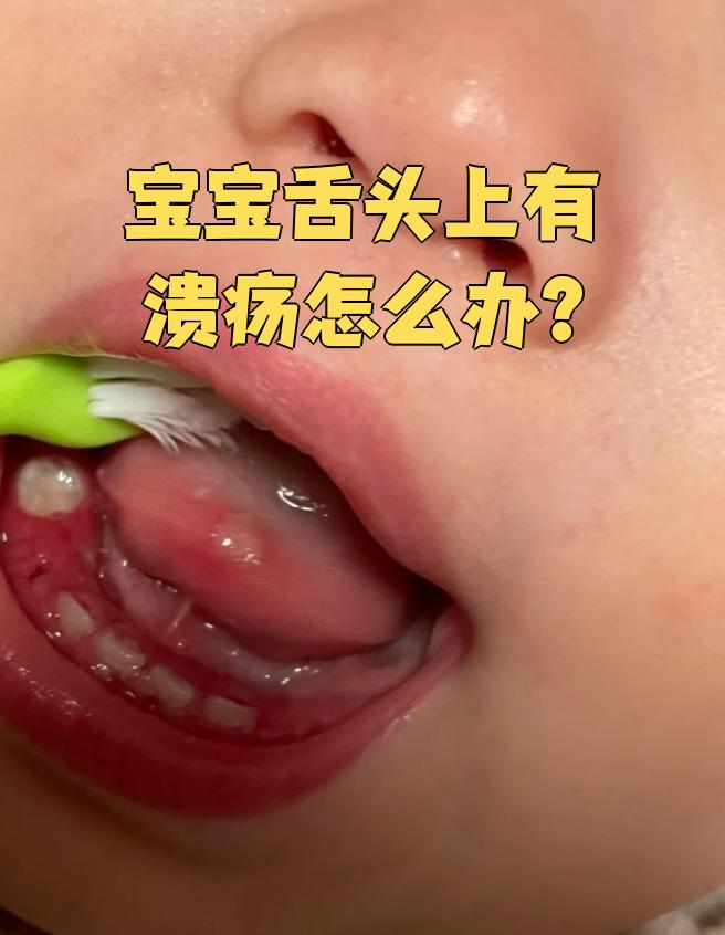 宝宝舌头溃疡首先要看是什么原因引起的