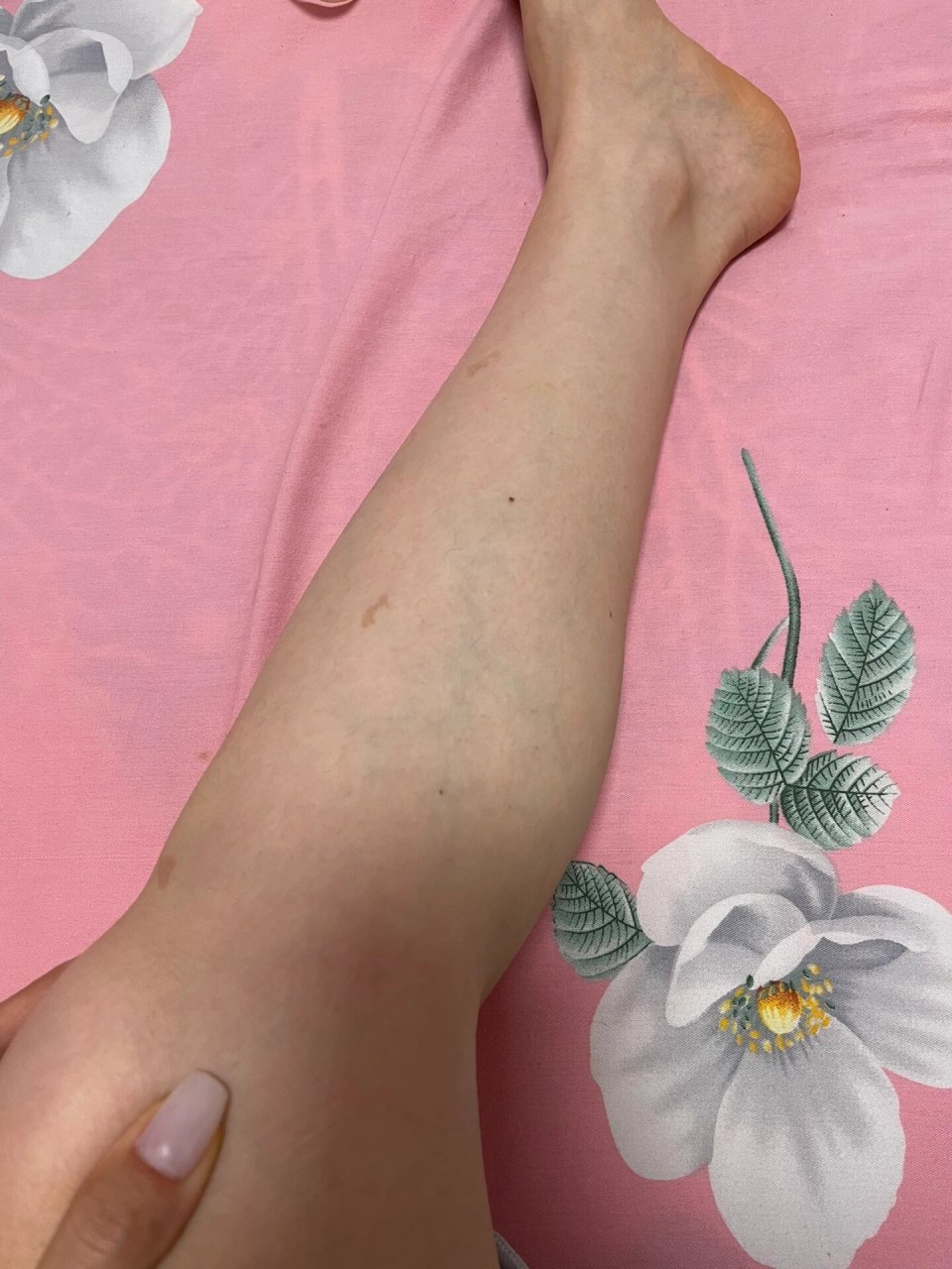 小腿血管明显是怎么回事