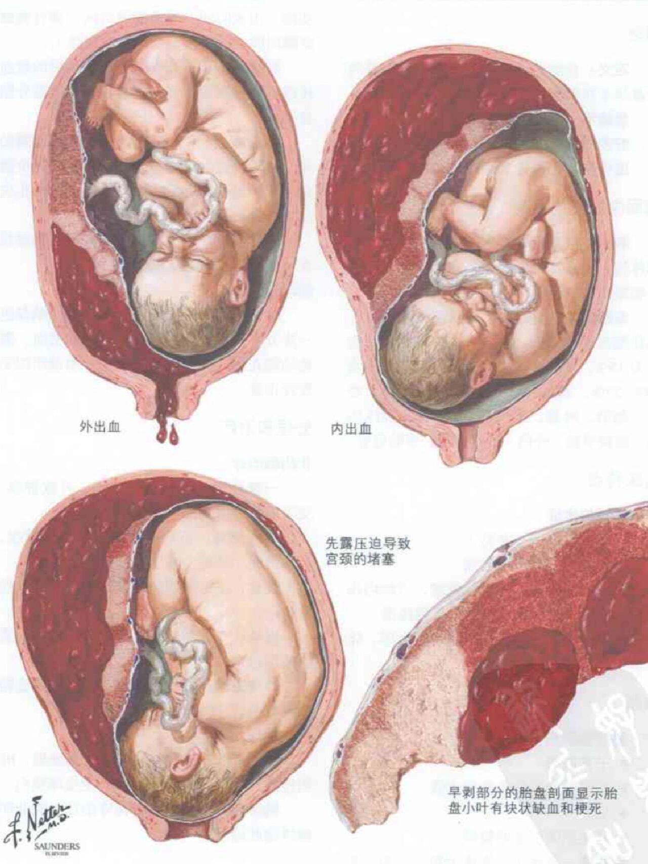 关于胎盘早剥你该知道的❗️