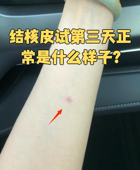 结核皮试第三天正常是什么样子?
