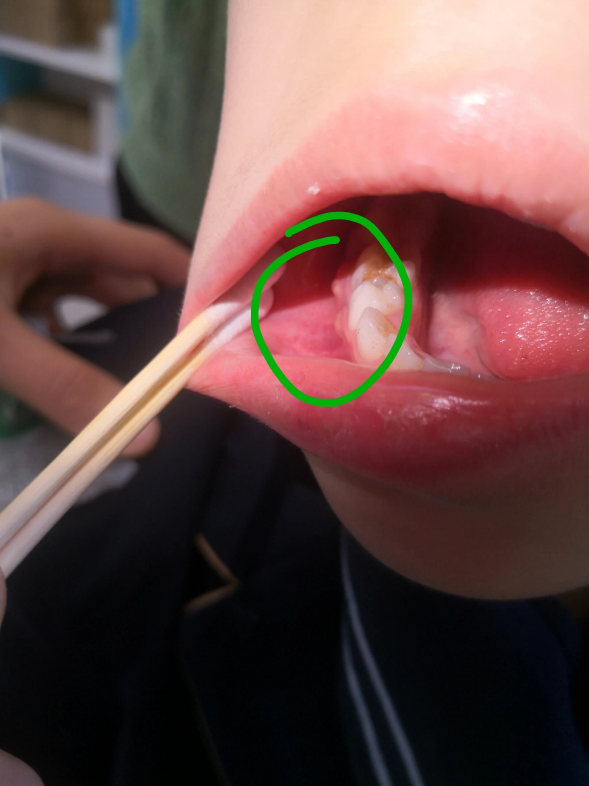 你们知道小朋友牙龈怎么会长脓包吗?