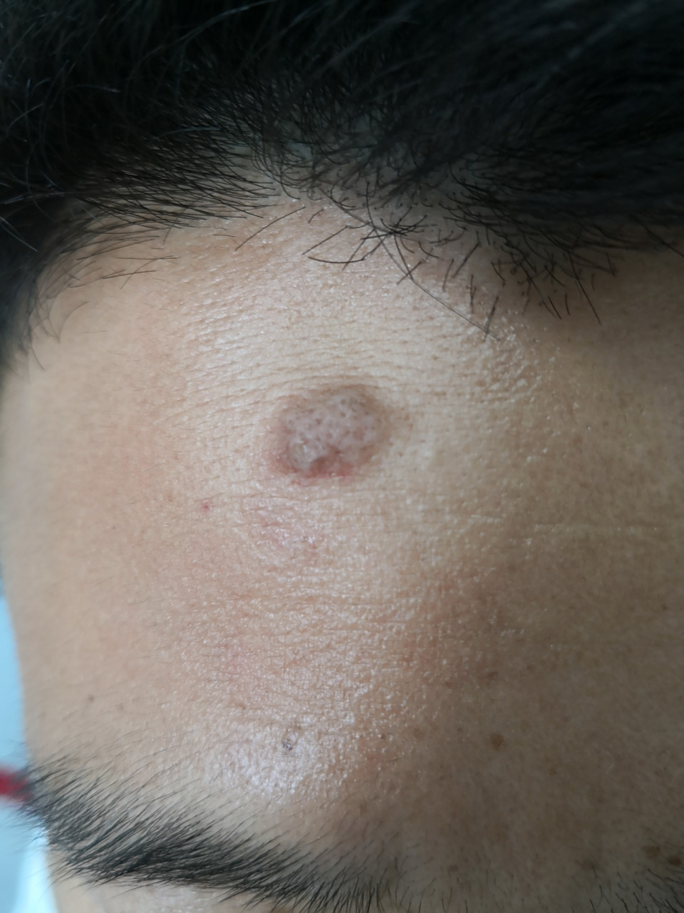 额头枕下的丘疹结节斑块症状.