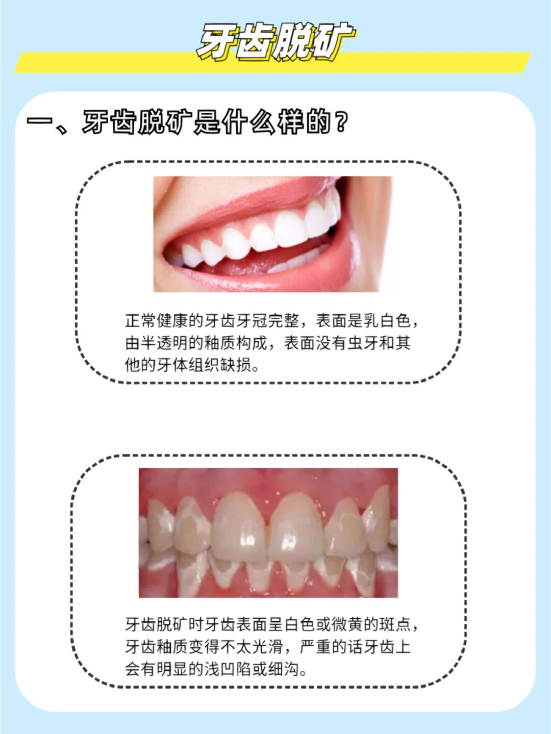 为什么好好刷牙牙齿还会脱矿,该怎么办