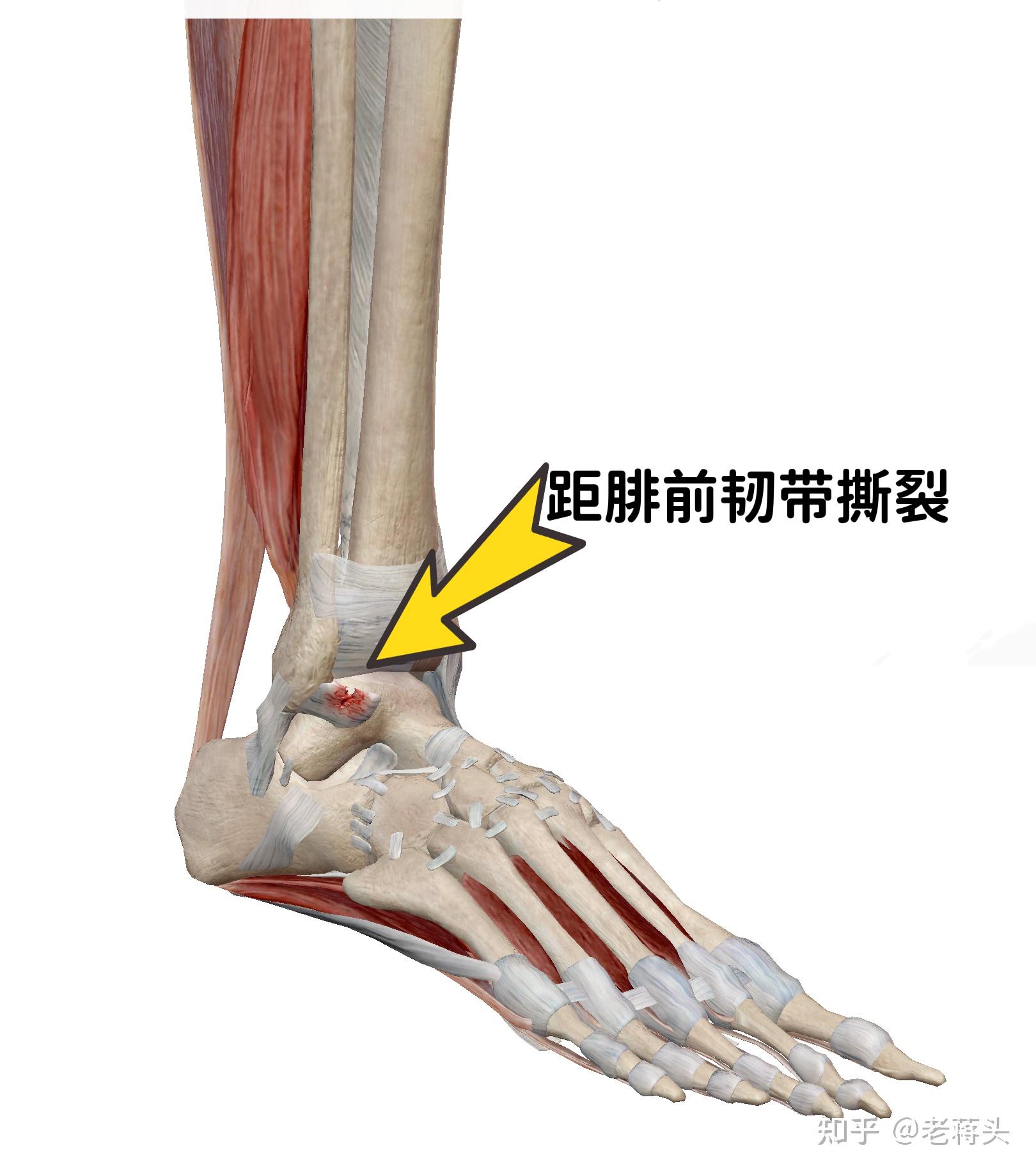 脚踝韧带撕裂多久可以走路