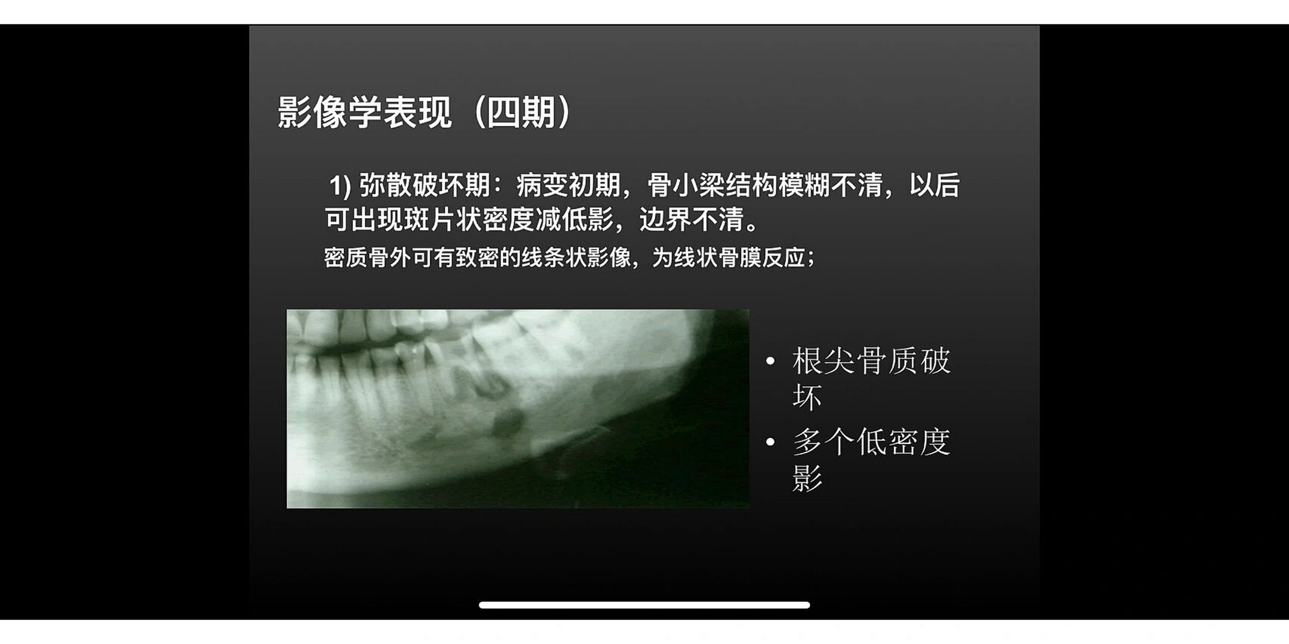 中央性颌骨骨髓炎和边缘性颌骨骨髓炎区别 影像学改变