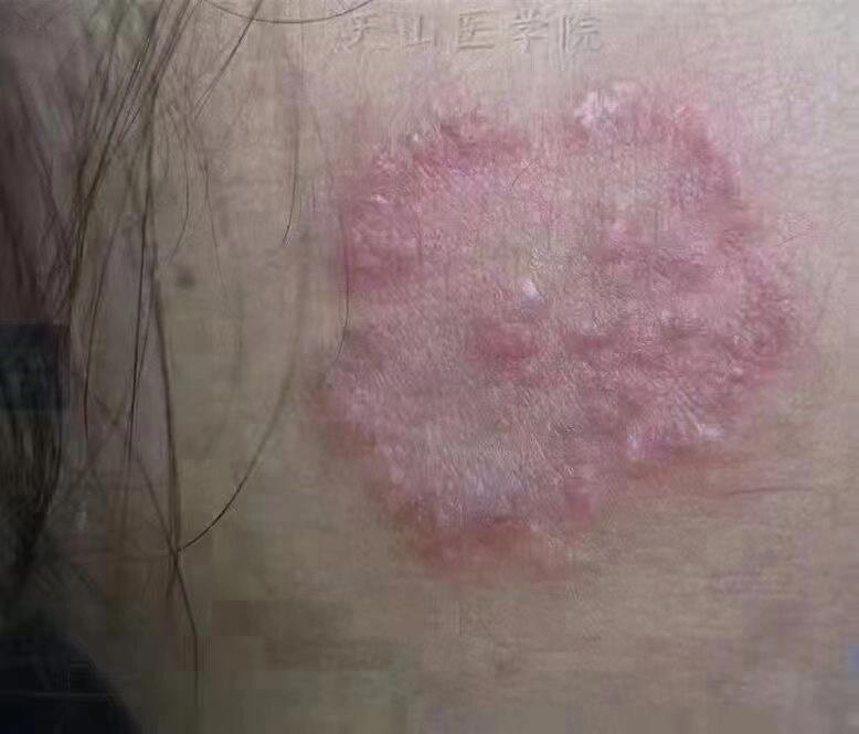 问:脚气会上"脸"吗 答:真的会60 抠抠脚……再摸摸脸 真菌传染脸上