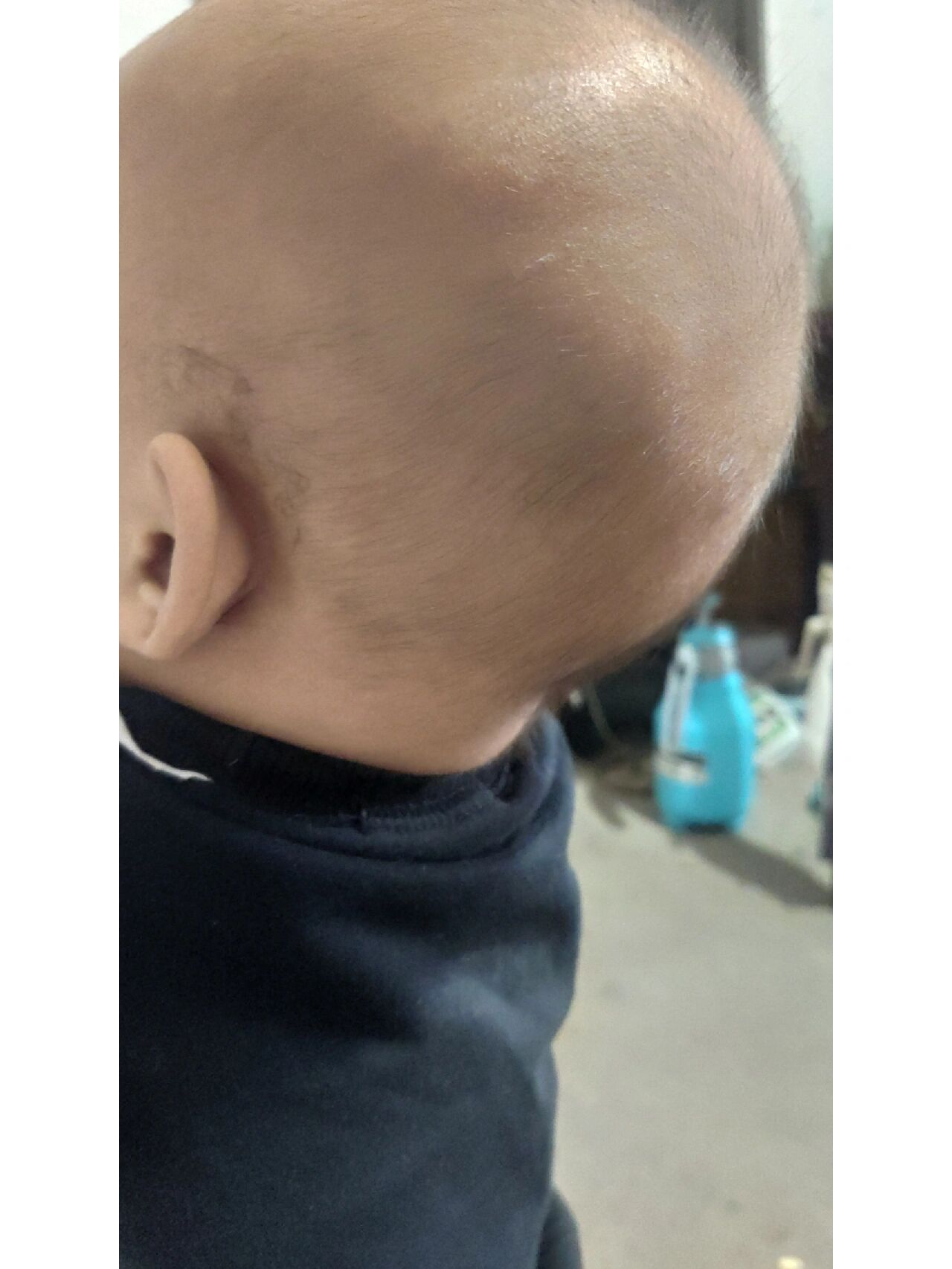 宝宝头上摸到一个软包