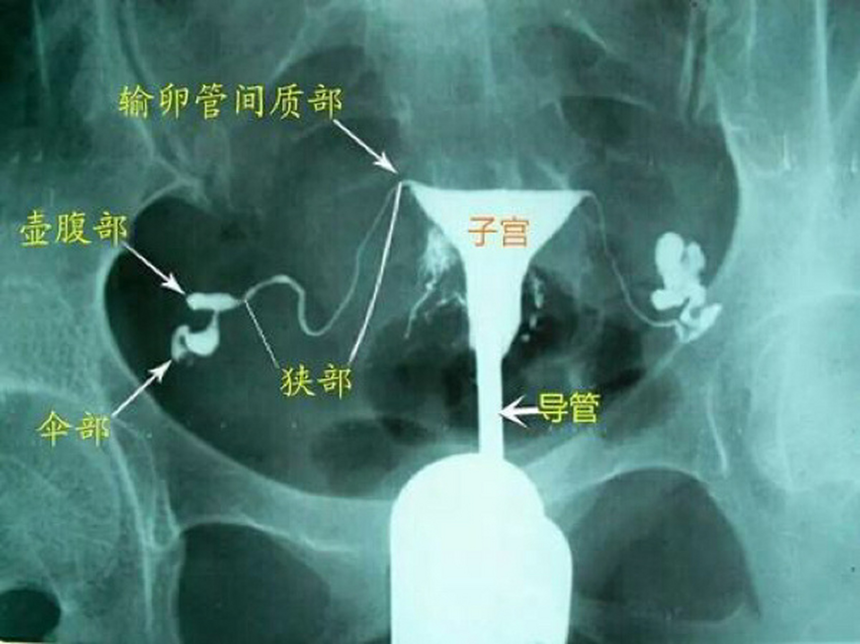 输卵管间质部图片