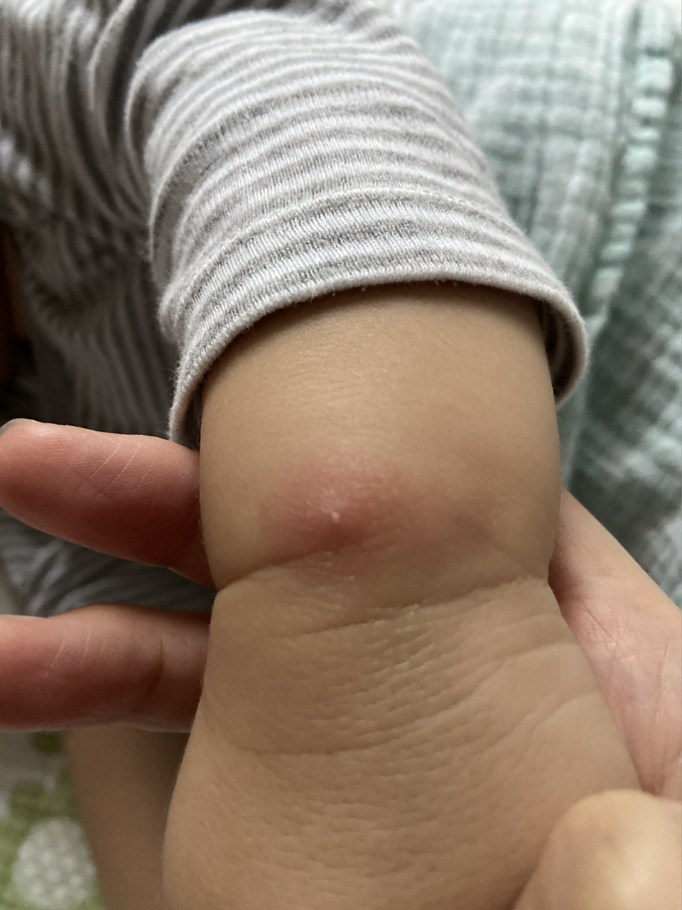 宝宝起火疖子(白头老)是怎么回事?