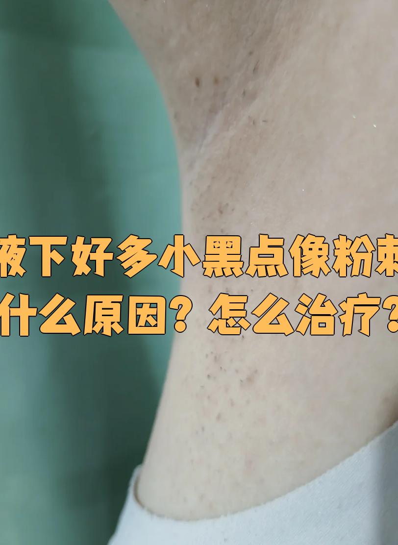 腋下好多小黑点像粉刺什么原因?怎么治疗?
