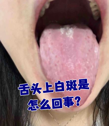 舌头上白斑是怎么回事?