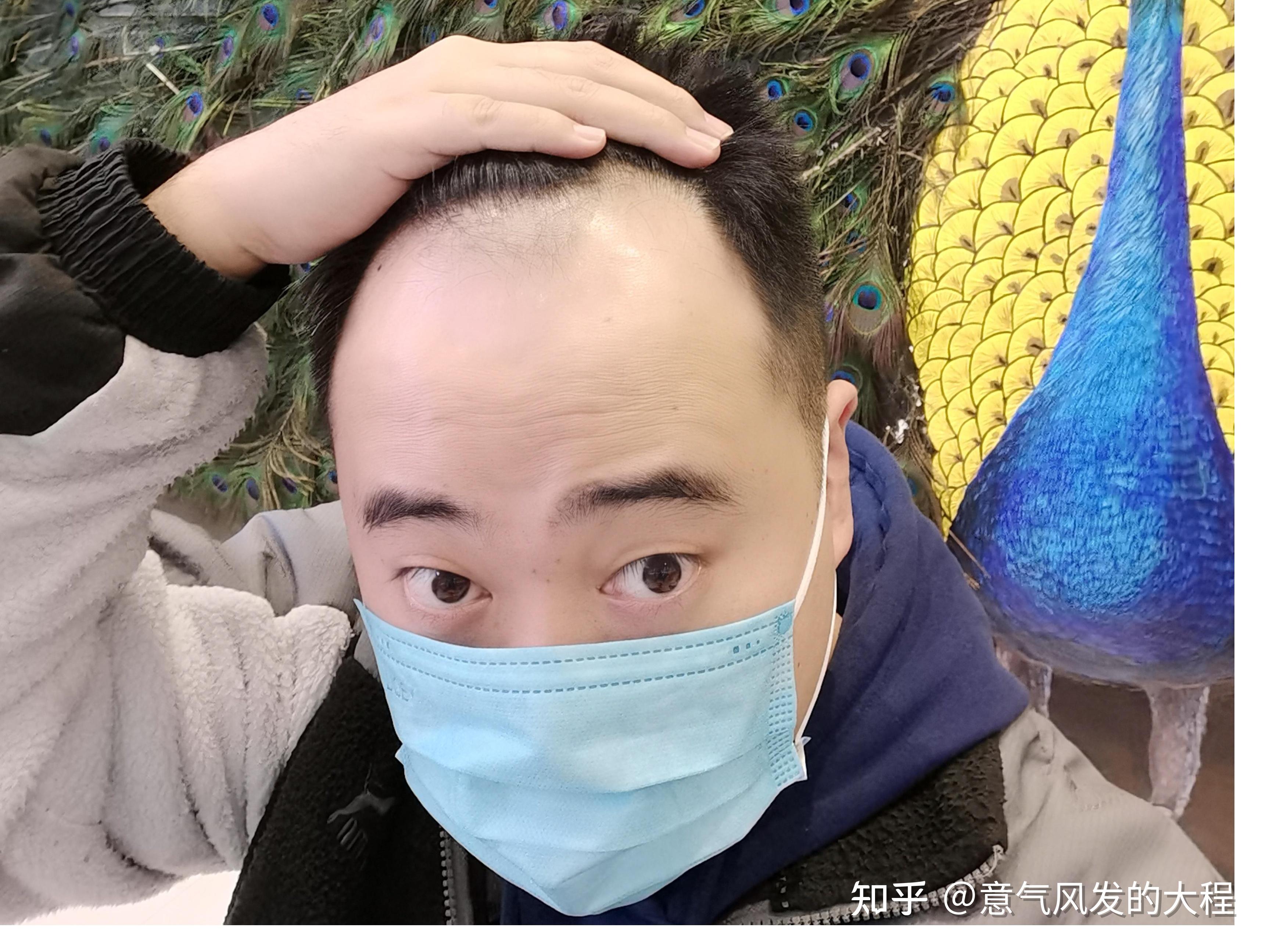 植发头皮屑多(植发头皮屑带着头发)